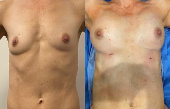 Thin patient before and after fat to breasts transfer.