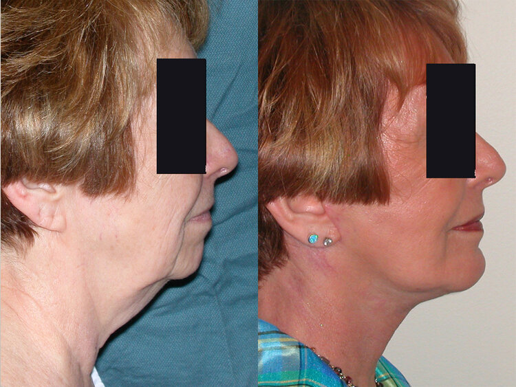 Before and After - Chin Augmentation