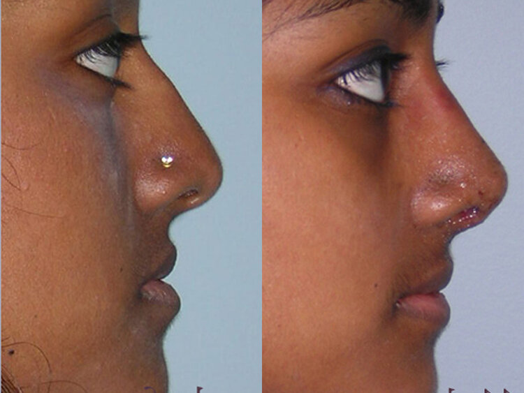 Before and After - Non-Caucasian Rhinoplasty