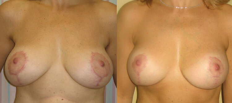 Before and After - Breast Augmentation + Lift