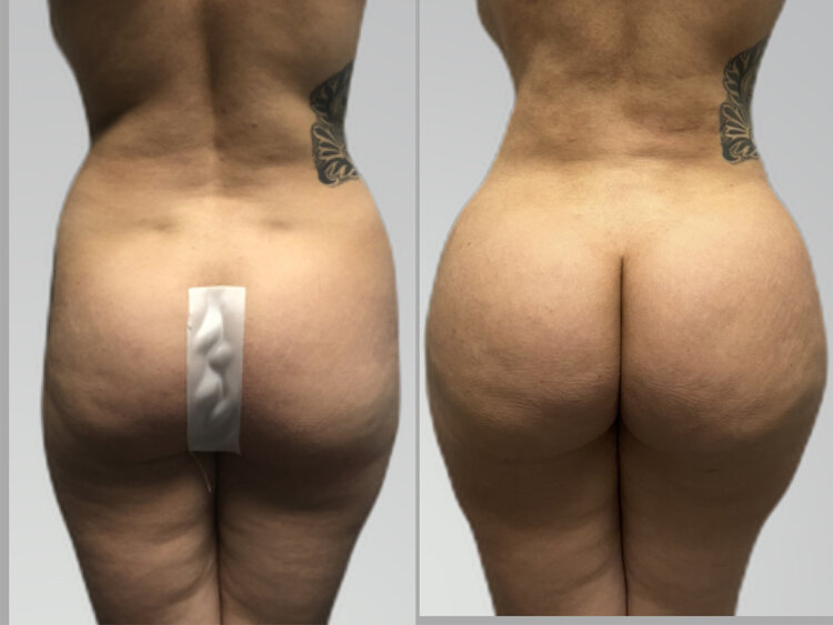 Before and After - Brazilian Butt Lift