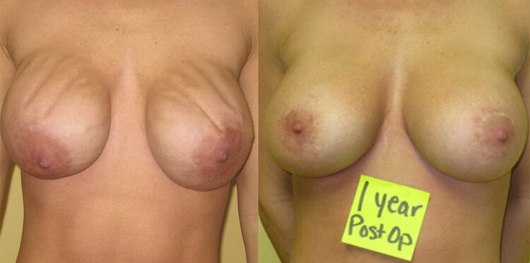 Before and After - Breast Revision
