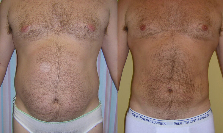 Before and After - Liposuction & HD Liposuction