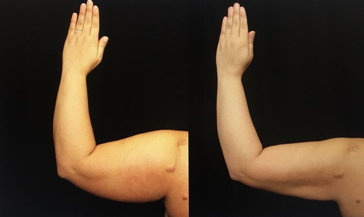 Before and After - Arm Lift
