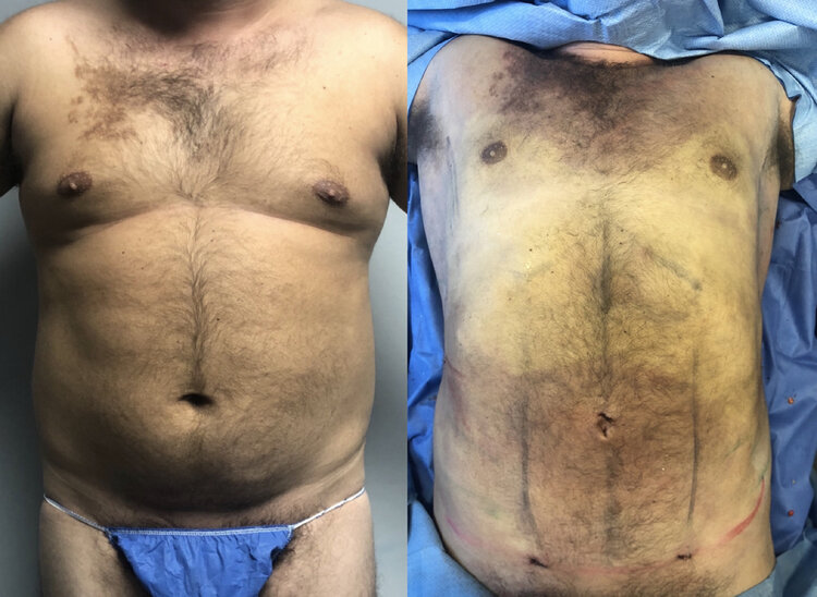 Before and After - Liposuction & HD Liposuction