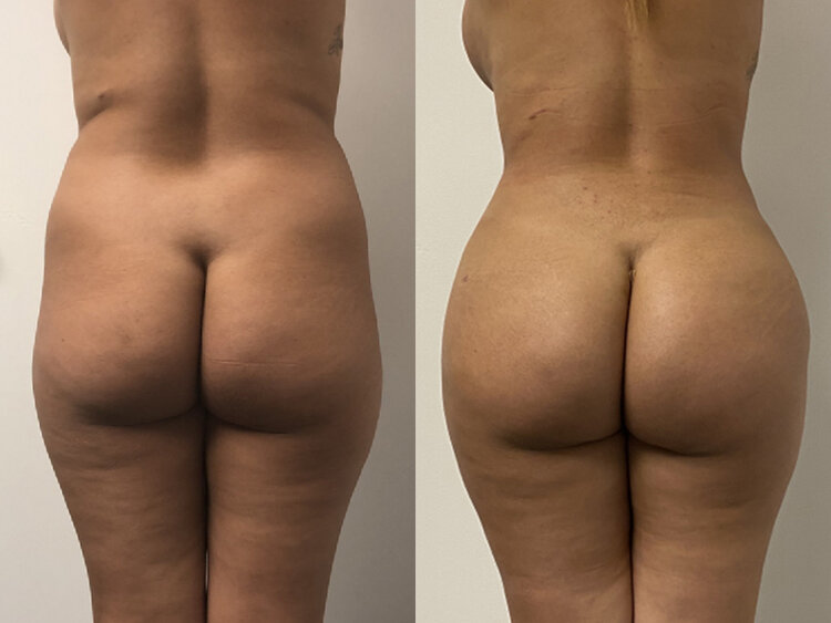 Before and After - Brazilian Butt Lift