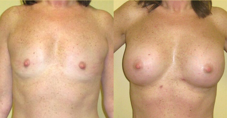 Before and After - Composite Implants and Fat