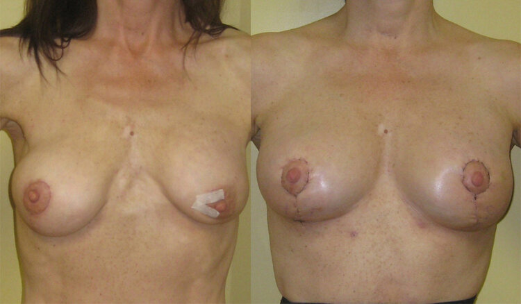 Before and After - Breast Revision