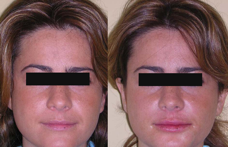 Before and After - Juvéderm