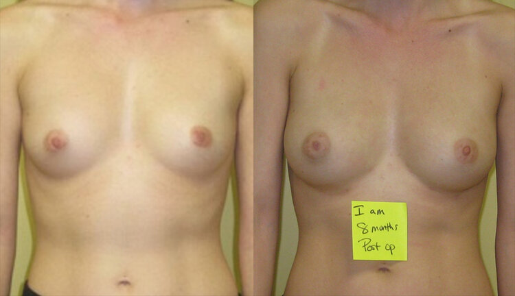 Before and After - Breast Fat Transfer