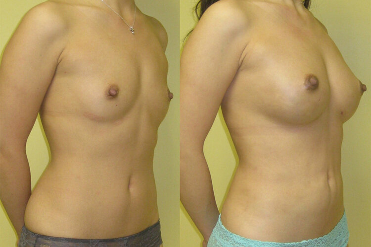 Before and After - Breast Fat Transfer
